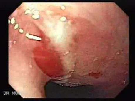 Multiple Gastric Angiodysplasia (5 of 17)