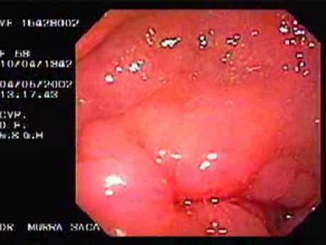 Gastric Adenocarcinoma of the Antrum - Endoscopy (1 of 2 )