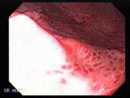 Acute Gastritis (Pangastritis) (1 of 10)