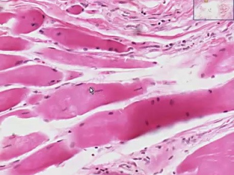 Muscular dystrophy