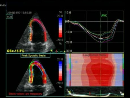 Dobutamine Echocardiogram