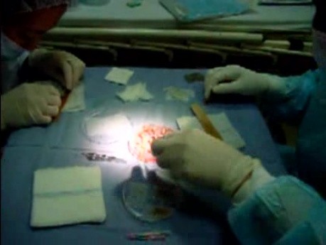Hair transplantation surgery