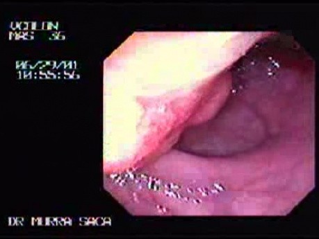 Rectum Adenocarcinoma - 36 Year - Old Man