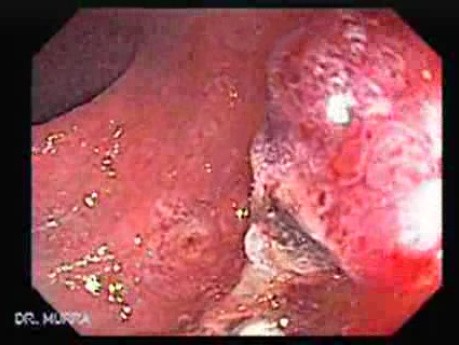 Pedicled Polyp (7 of 7)