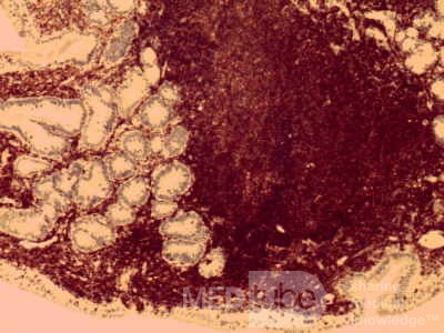 Gastric lymphoma with metastases to the duodenum (13 of 15)