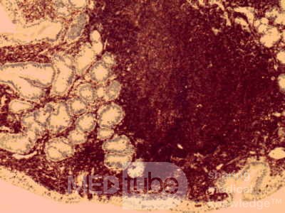 Gastric lymphoma with metastases to the duodenum (13 of 15)