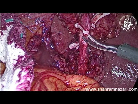 Step By Step Laparoscopic Cholecystectomy