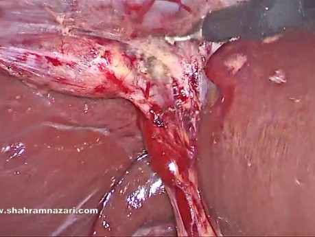 Left-sided Gallbladder Laparoscopic Cholecystectomy