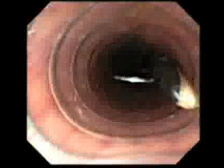 Passage Of The Needle With Thread Through The Overtube - 2/2