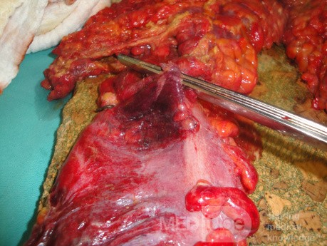 Multiple Rectal Ulcers (77 of 110)