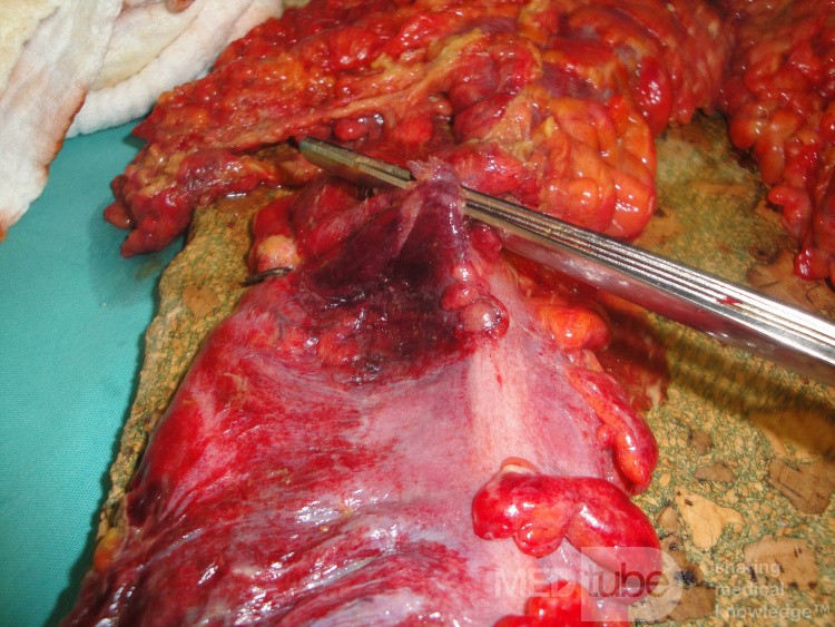 Multiple Rectal Ulcers (77 of 110)