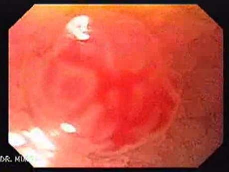 Brunner's Gland Hyperplasia (1 of 5)