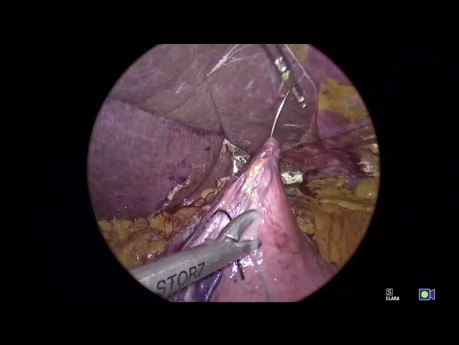 Geometry Fundoplication App Tutorial, Chapter 07 - Calibration of the Fundoplication