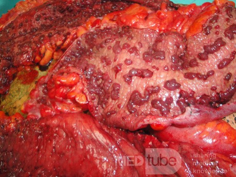 Multiple Rectal Ulcers (90 of 110)
