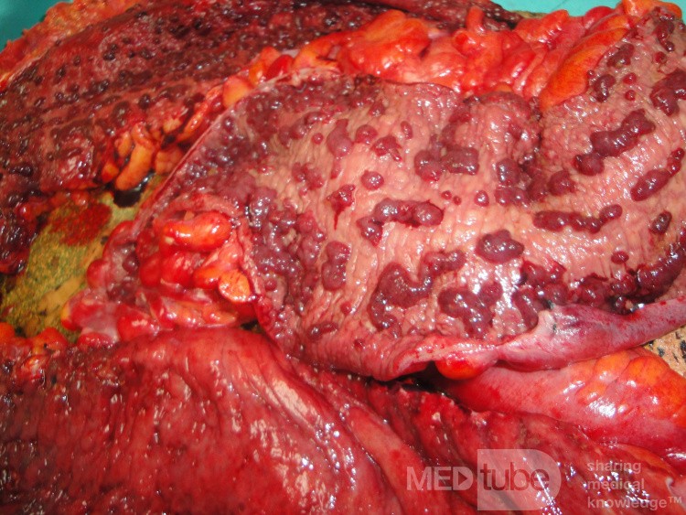 Multiple Rectal Ulcers (90 of 110)
