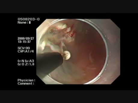 ESD For Barrett's Cancer Developed From LSBE 