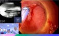 ERCP Gastroscope