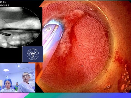 ERCP Gastroscope