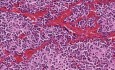 Neuroblastoma - Histopathology - Adrenal