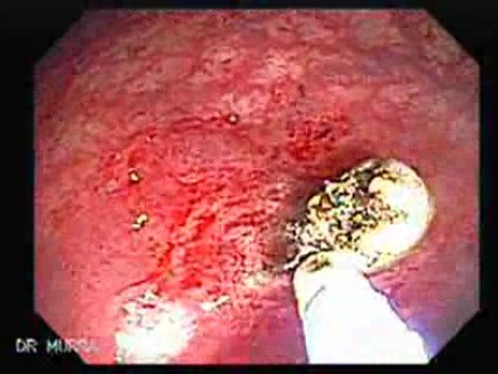 Endoscopic view of Rectal Stalked Polyp (7 of 7)