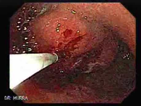 Gastrointestinal Stromal Tumor - GIST (7 of 13)