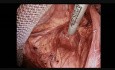 Laparoscopic Groin Hernia Repair, Step 8: Mesh Coverage of Femoral Ring