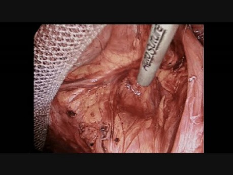 Laparoscopic Groin Hernia Repair, Step 8: Mesh Coverage of Femoral Ring
