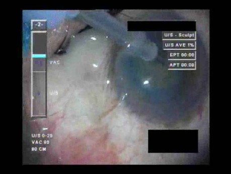 Swollen Conjunctiva - Part 2