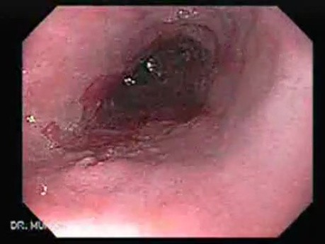 Barrett Esophagus - endoscopic view  (9 of 9)