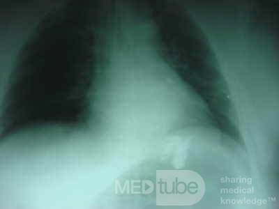 Large Gastric Varices (23 of 25)