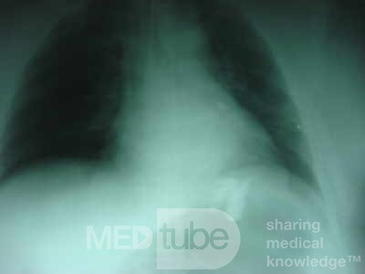 Large Gastric Varices (23 of 25)