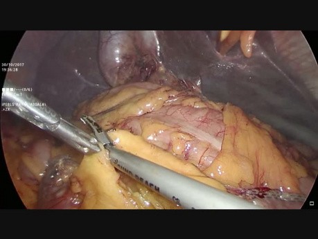 Laparoscopic Hepaticojejunostomy
