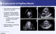 Echo Features in Patients with Hypertrophic Cardiomyopathy - A Journey Through the Echo Lab
