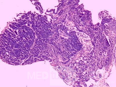 Heterotopic Pancreas with large Central Hole (5 of 6)