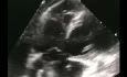 A Case of Pulmonary Embolism with Thrombus in Transit