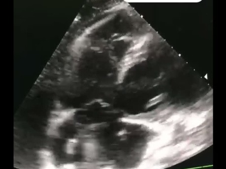 A Case of Pulmonary Embolism with Thrombus in Transit