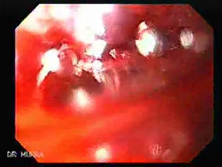 Perforation of a Esophageal Carcinoma after the procedure with hydrostatic balloon dilation (2 of 12)