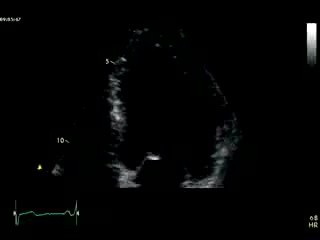 Acute Coronary Syndrome In Cardiac Echo
