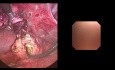 Laparoscopic Cholecystectomy + Bile Duct Exploration by Choledoscopy