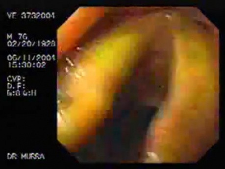 Larynx with ictericia (yellowish color)