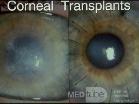Pre and Post Corneal Transplant