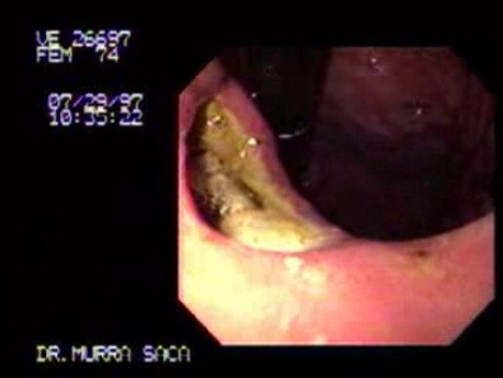 Gastric Ulcer