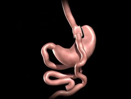 Gastric Bypass Animation