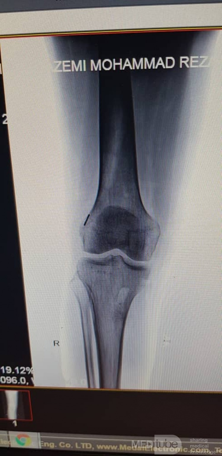 ACL Reconstruction (1/2)