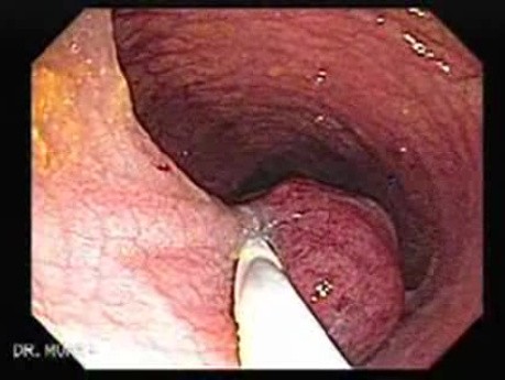 Huge Mass Of The Descending Colon (4 of 25)
