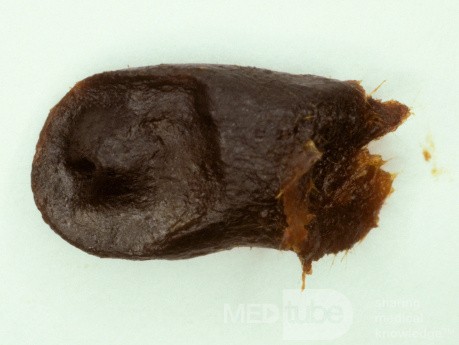 Massive Cerumen Plug Deep Canal