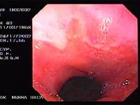 Barrett´s Esophagus (1 of 2)