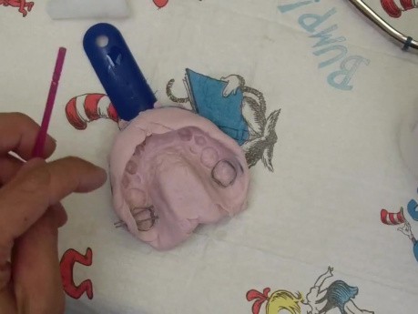 Rapid Palatal Expansion Device - Step 2