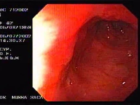 Crohn´s Disease (21 of 28)