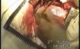 Esophageal Cancer Surgery